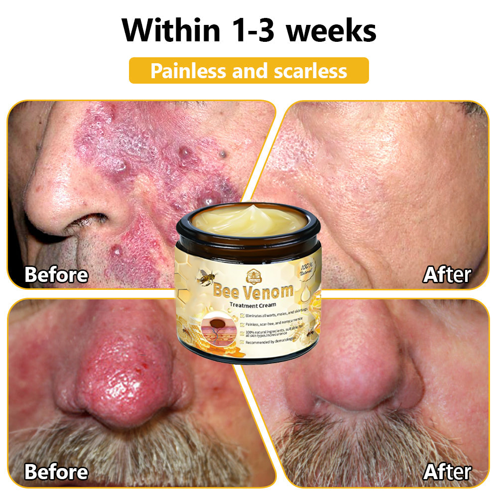 BSWELL™ Bee Venom Skin Treatment Cream (AAD Recommended)🎉🎉