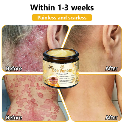 BSWELL™ Bee Venom Skin Treatment Cream (AAD Recommended)🎉🎉