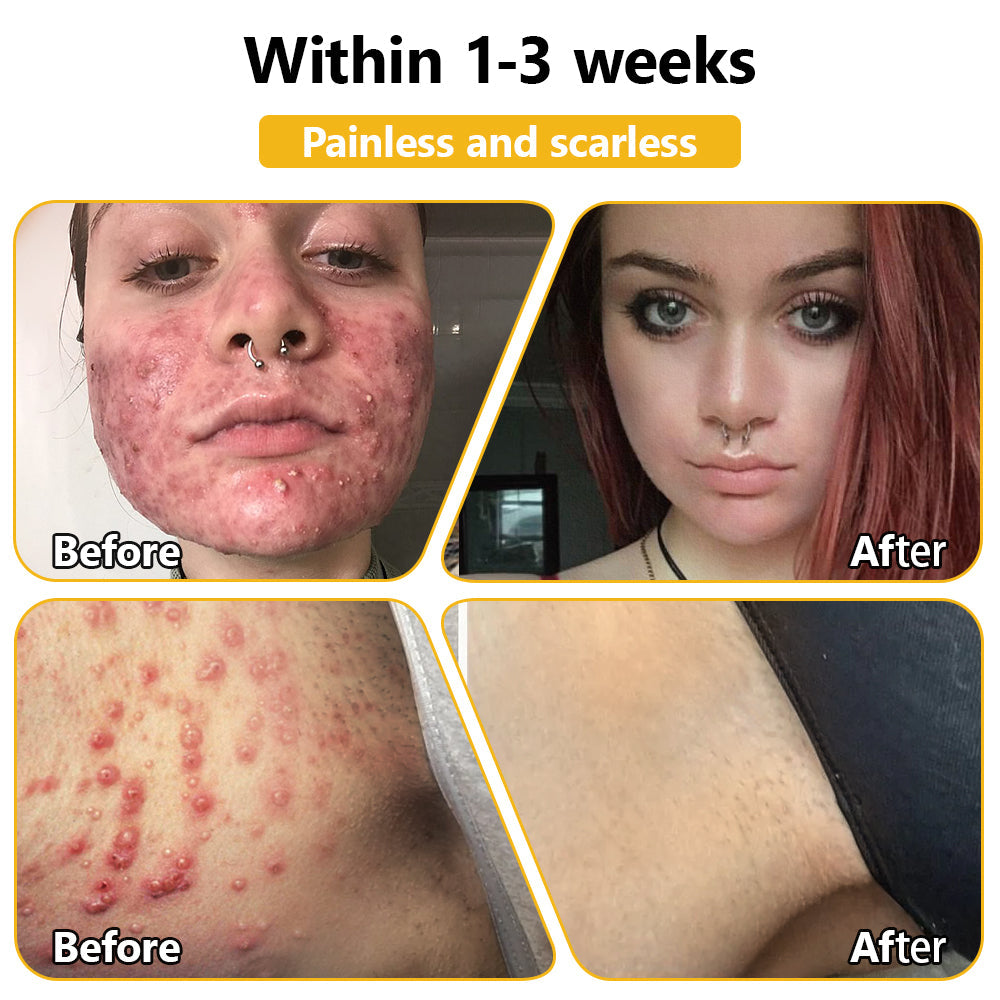 BSWELL™ Bee Venom Skin Treatment Cream (AAD Recommended)🎉🎉